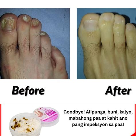 gamot sa mabahong paa at sapatos|Foot Odor o mabaho o pangangamoy ng paa: Gamot .